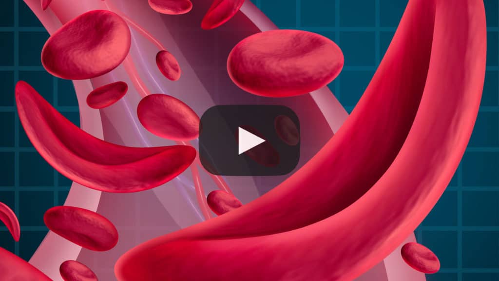 nbmtLINK sickle cell webinar